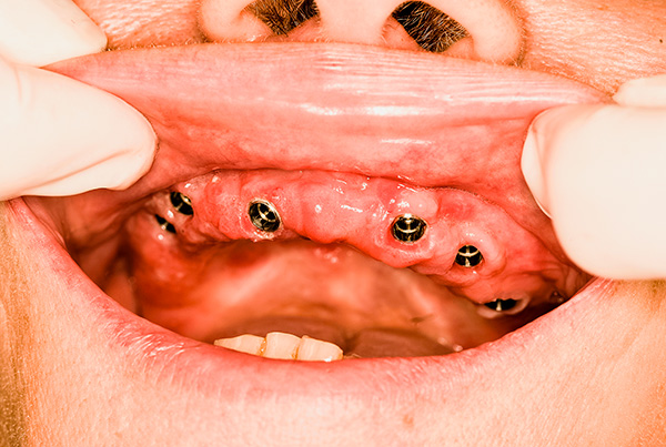 علاج التهاب اللثة بعد زراعة الاسنان